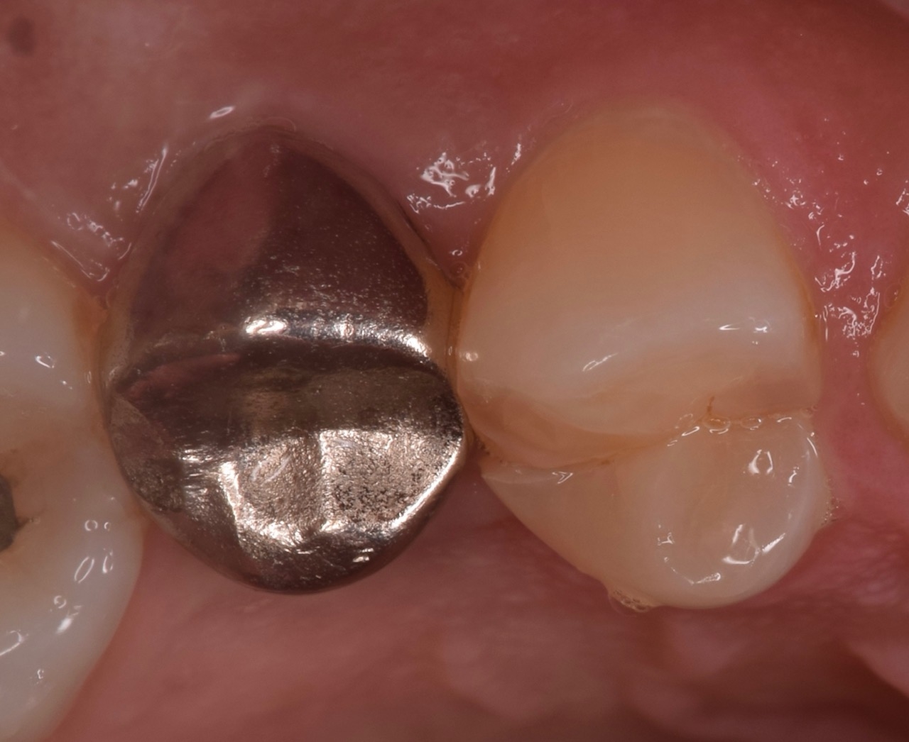 歯ぎしりによる歯牙破折