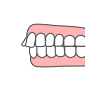 上顎前突(出っ歯)