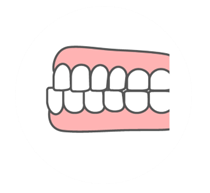 反対咬合(受け口)