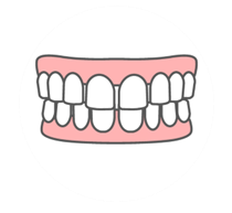 空隙歯列(すきっ歯)