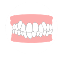 叢生（乱ぐい歯・ガチャ歯）