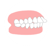 上顎前突（出っ歯）