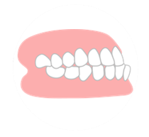 反対咬合（受け口）