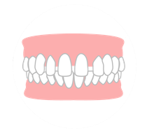 空隙歯列（すきっ歯）