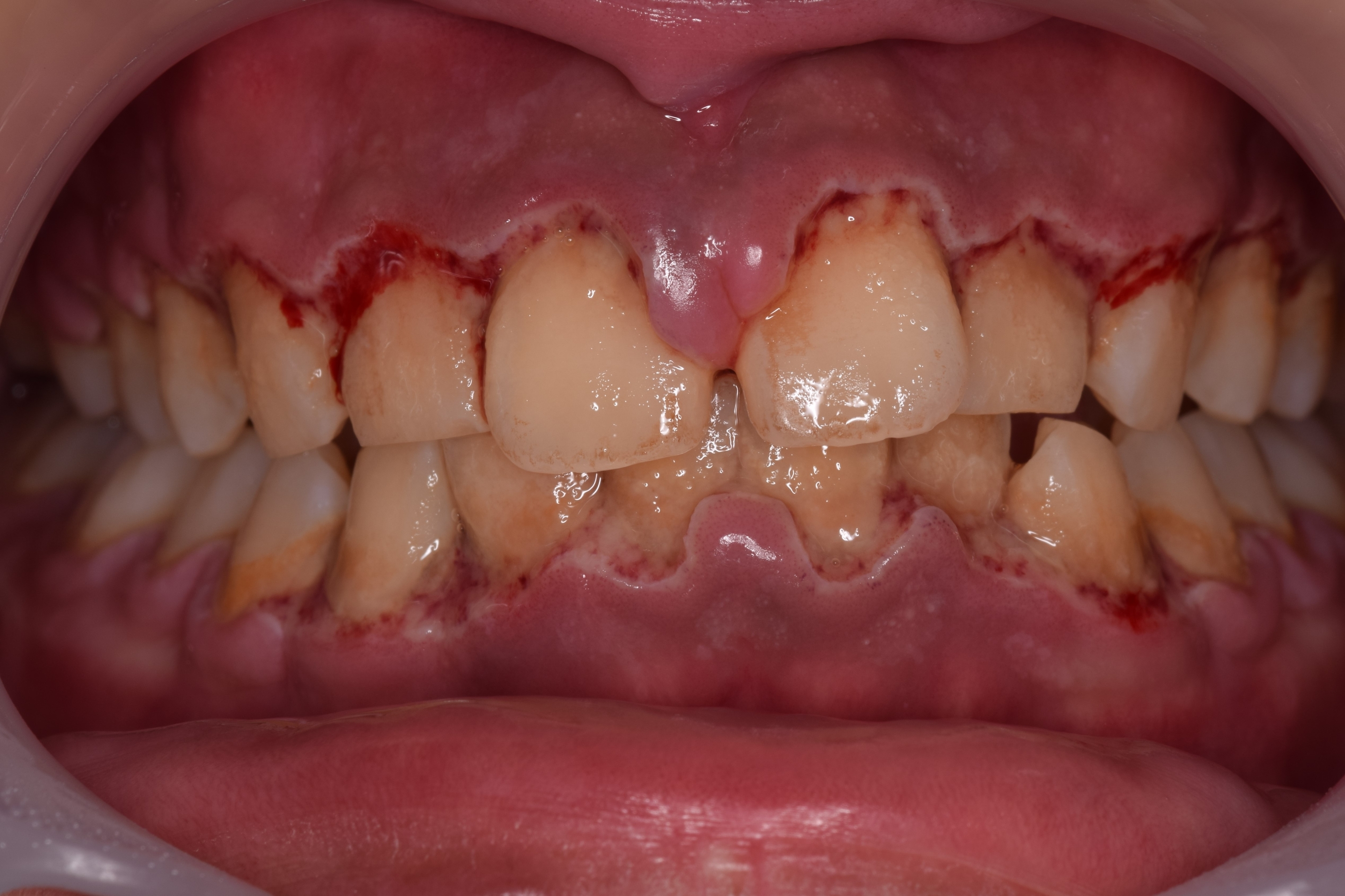 歯ぐきの腫れに対するホームケア