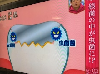 銀歯の下に虫歯