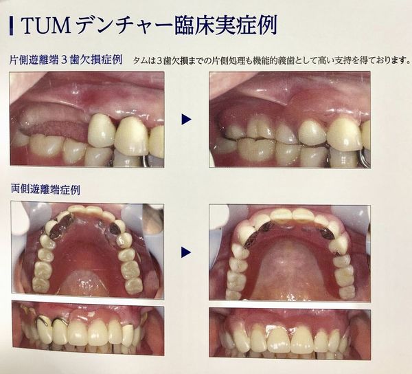 ソケット コンフォート コンフォート入れ歯クリニックの口コミ評判｜入れ歯の名医ナビ