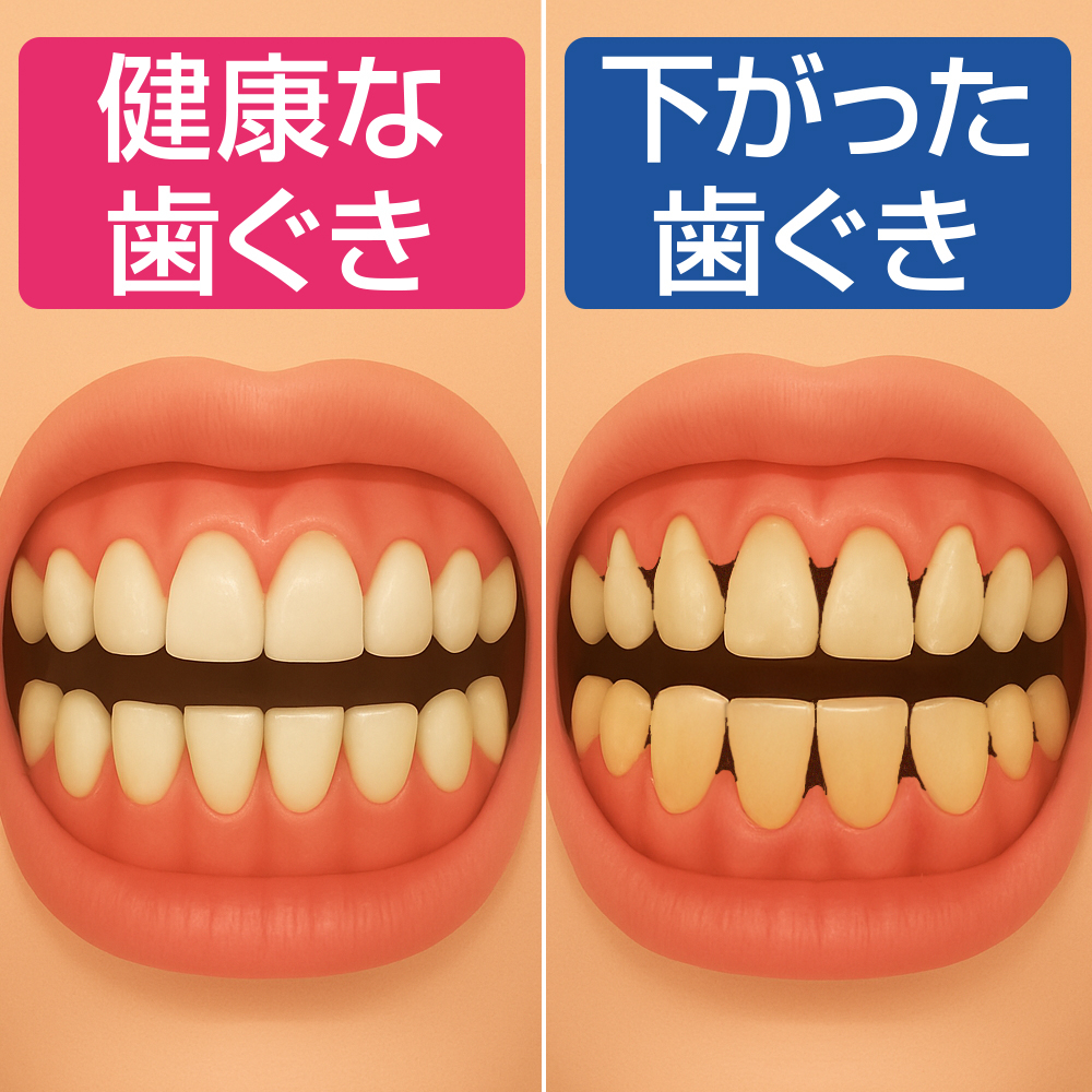 歯茎下がり