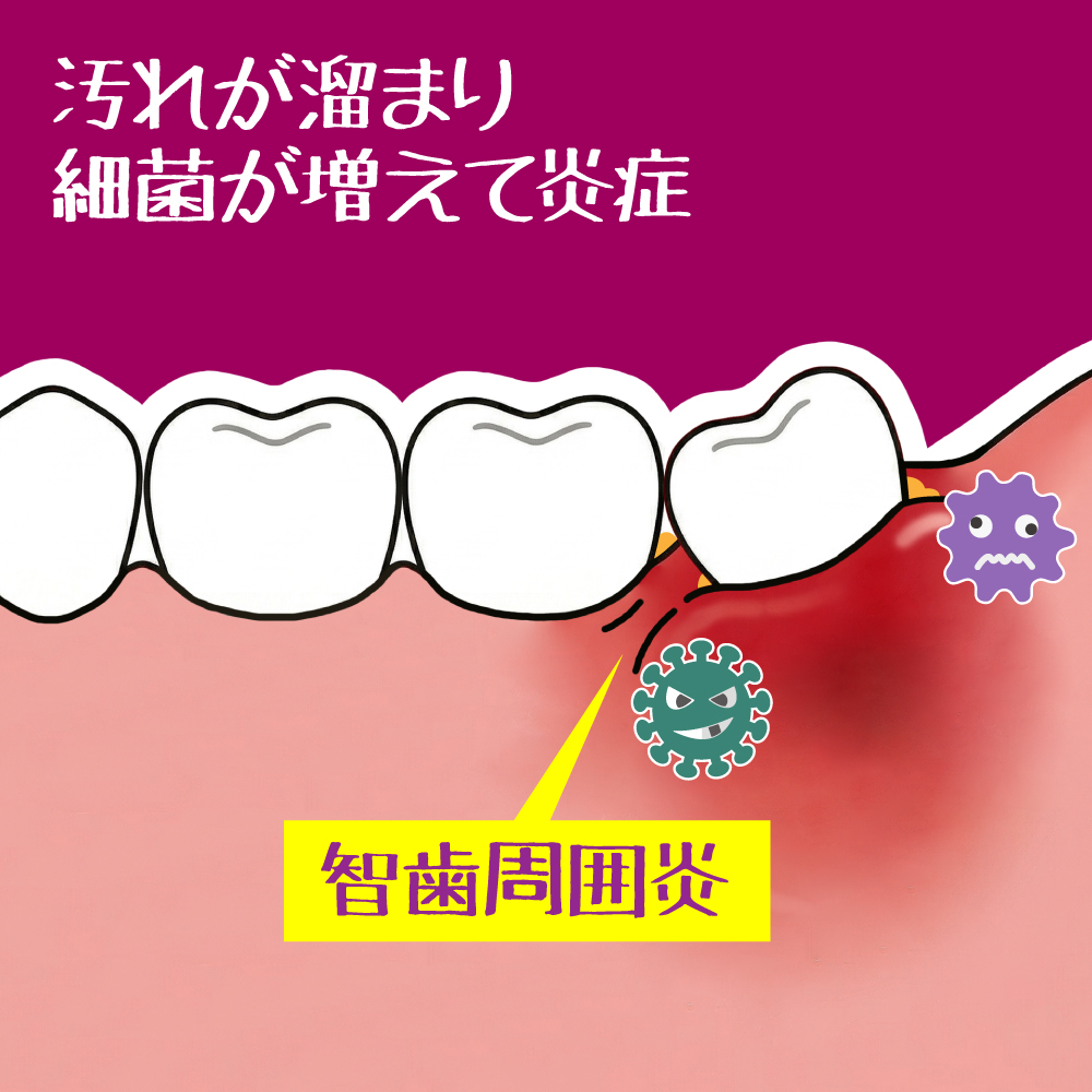智歯周囲炎