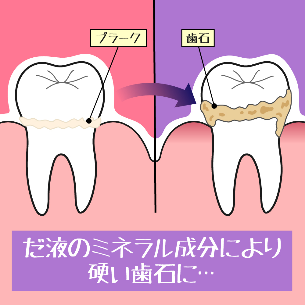 歯石